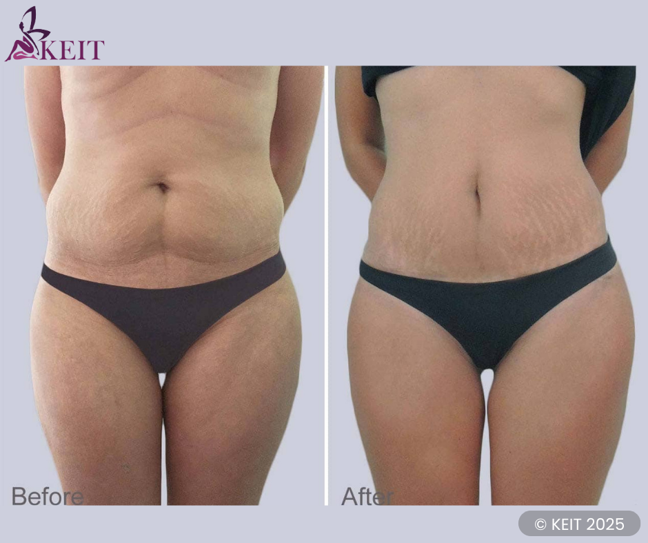 liposuction before and after