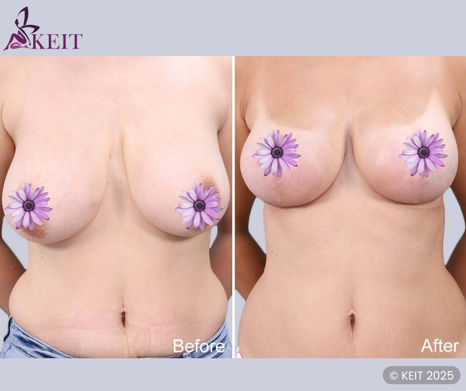 mastopexy before and after