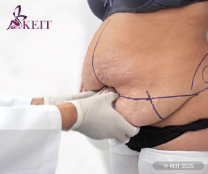Abdominoplasty Risks and Complications: A Mini-Systematic Review and Meta-Analysis Round-Up