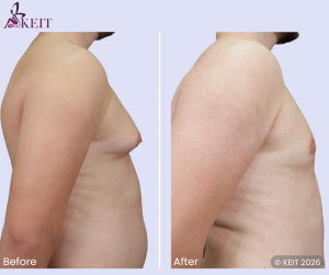 Gynecomastia Surgery Risks: A Mini-Systematic Review and Evidence Round-Up (2021–2025)