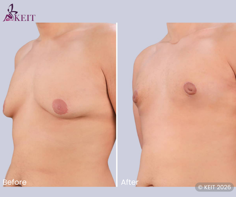 Gynecomastia surgery