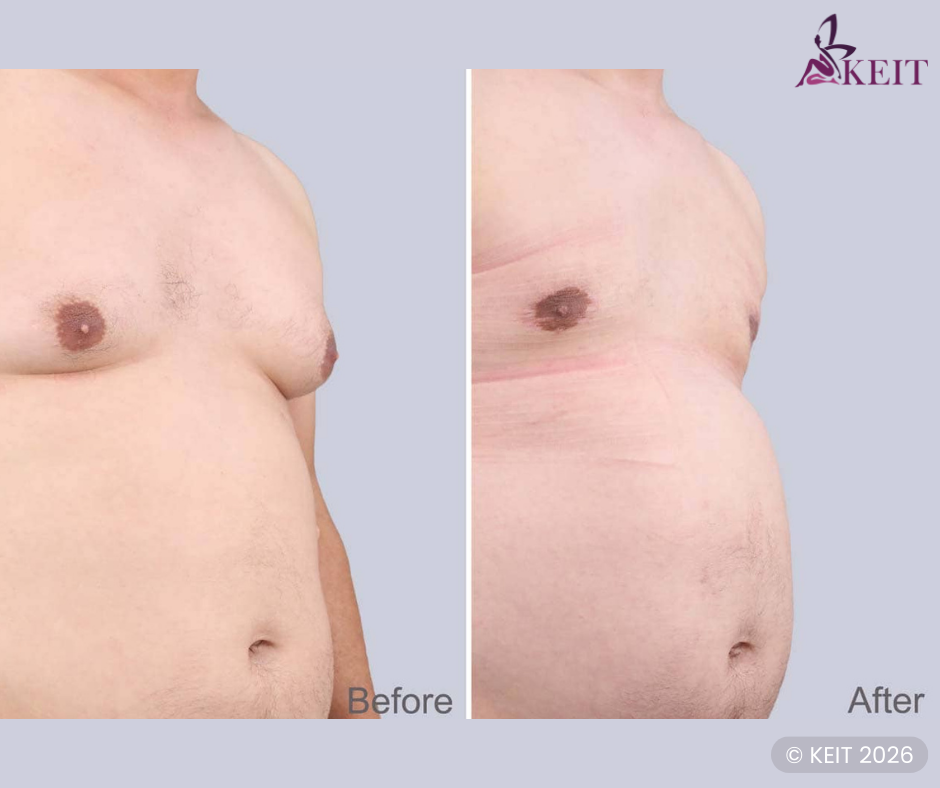Gynecomastia surgery risks