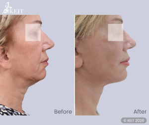 Mini-Facelift vs Traditional Facelift: Evidence from Comparative Studies