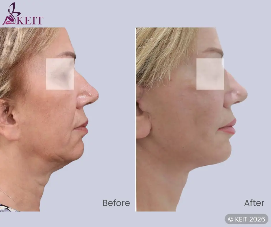 Turkey neck: causes, signs, treatments and neck lift surgery