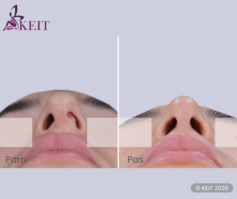 septoplastika para pas